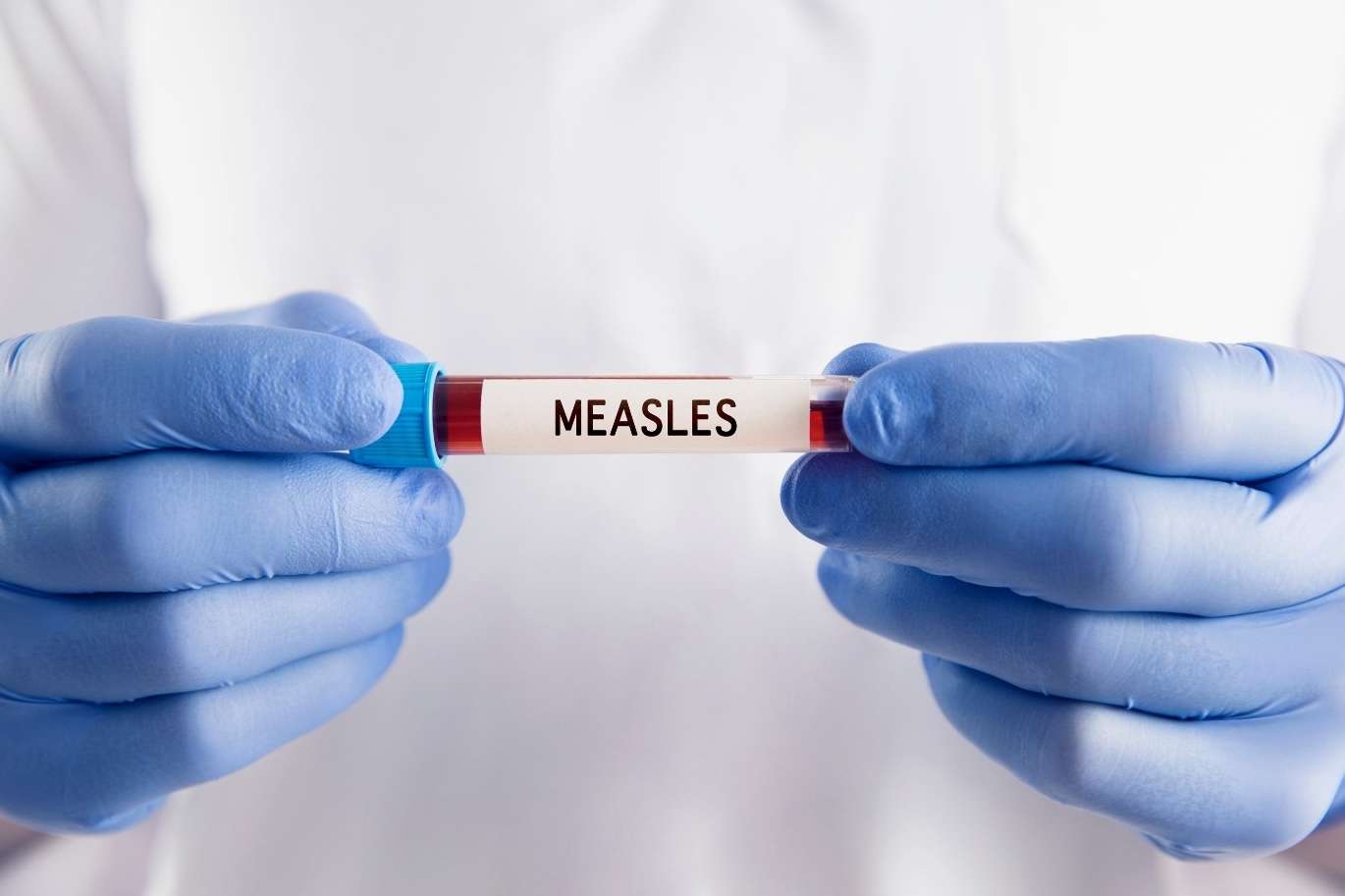 Strong Vaccination Programme Keeps Antigua and Barbuda Measles-Free